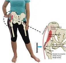 Woman standing with weight shifted to one hip, causing lateral hip pain