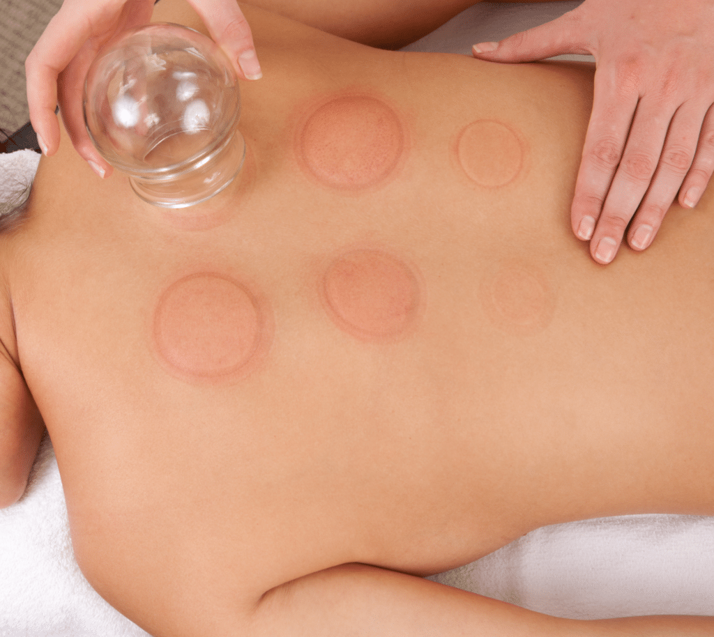 Texas massage therapist using cupping technique on a patient's back for back pain