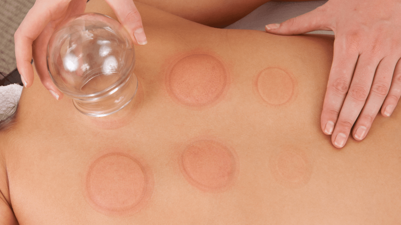 Massage therapist cupping a patient to help with back pain