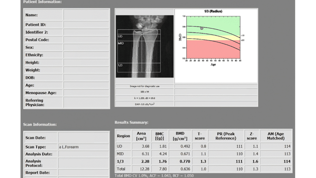 Medical results of a bone scan showing density to help patients learn How PT Helps Prevent Osteoporosis During Menopause in Austin Texas